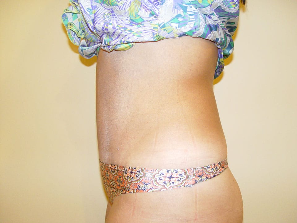 Before & After Patient