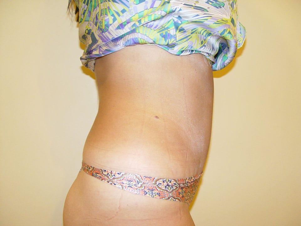 Before & After Patient