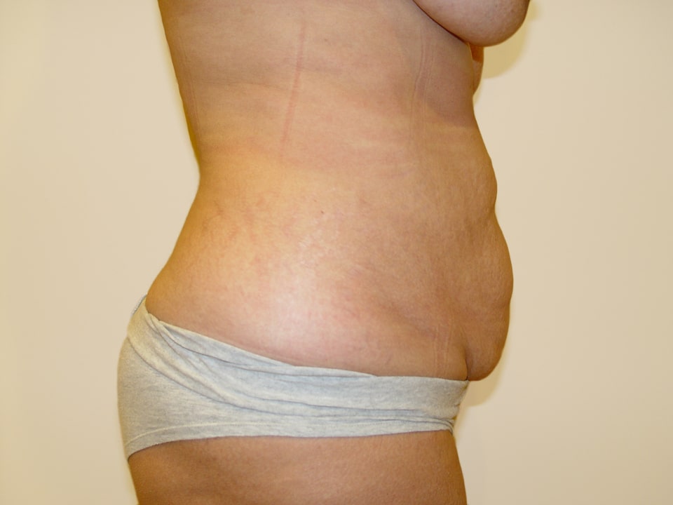 Before & After Patient