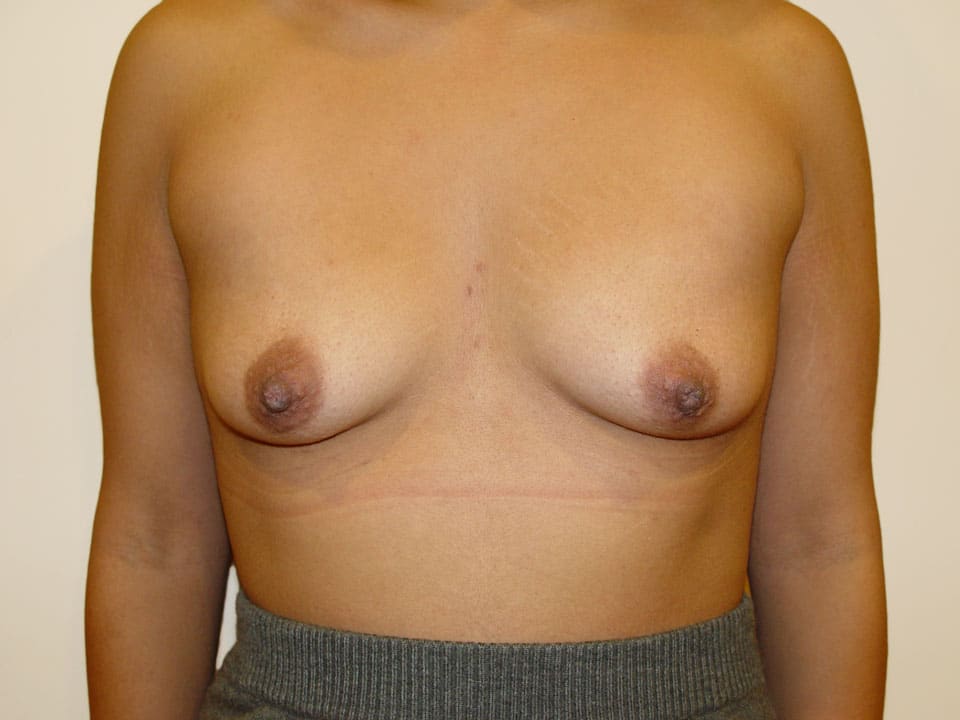 Before & After Patient