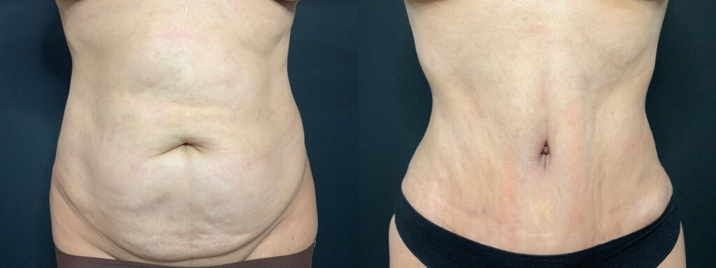 Tummy Tuck Patient
