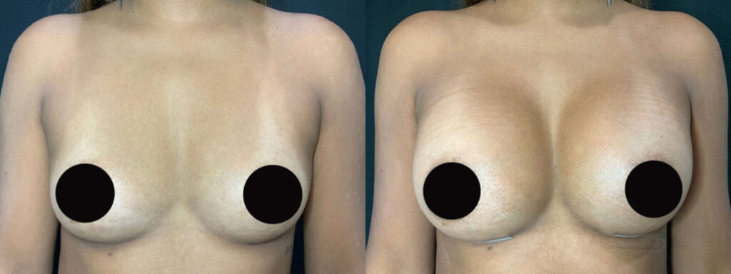 Breast Augmentation Patient